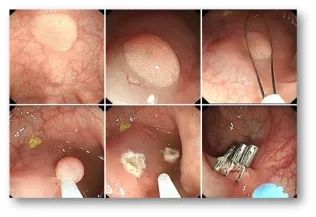 为什么说热活检钳为什么发现就要切？肠道里的“定时炸弹”，你了解吗_https://www.jmylbn.com_新闻资讯_第10张