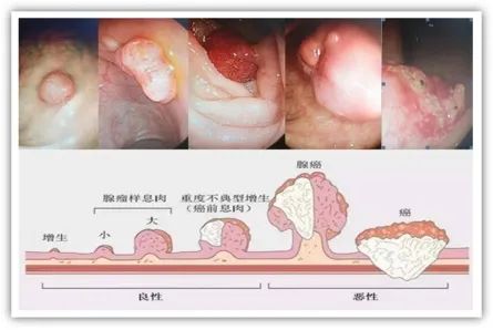 为什么说热活检钳为什么发现就要切？肠道里的“定时炸弹”，你了解吗_https://www.jmylbn.com_新闻资讯_第4张