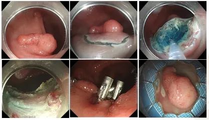 为什么说热活检钳为什么发现就要切？肠道里的“定时炸弹”，你了解吗_https://www.jmylbn.com_新闻资讯_第12张