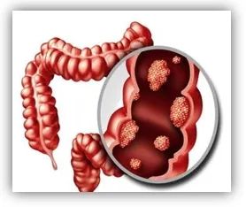 为什么说热活检钳为什么发现就要切？肠道里的“定时炸弹”，你了解吗_https://www.jmylbn.com_新闻资讯_第3张